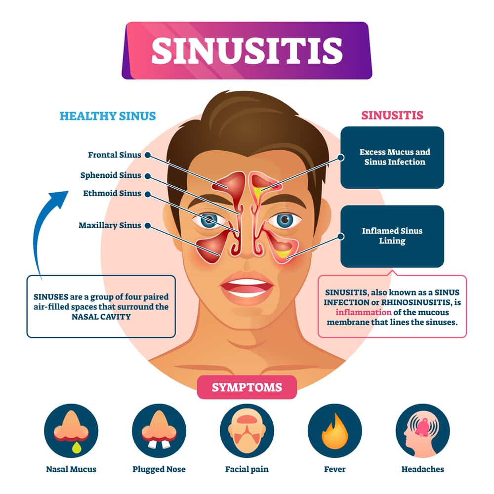 Structure of Sinuses and how they work